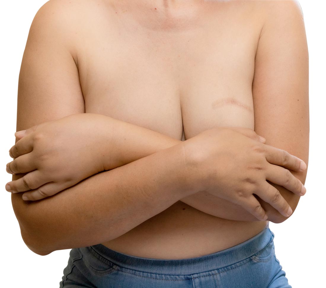 Breast Reconstruction for Breast Cancer