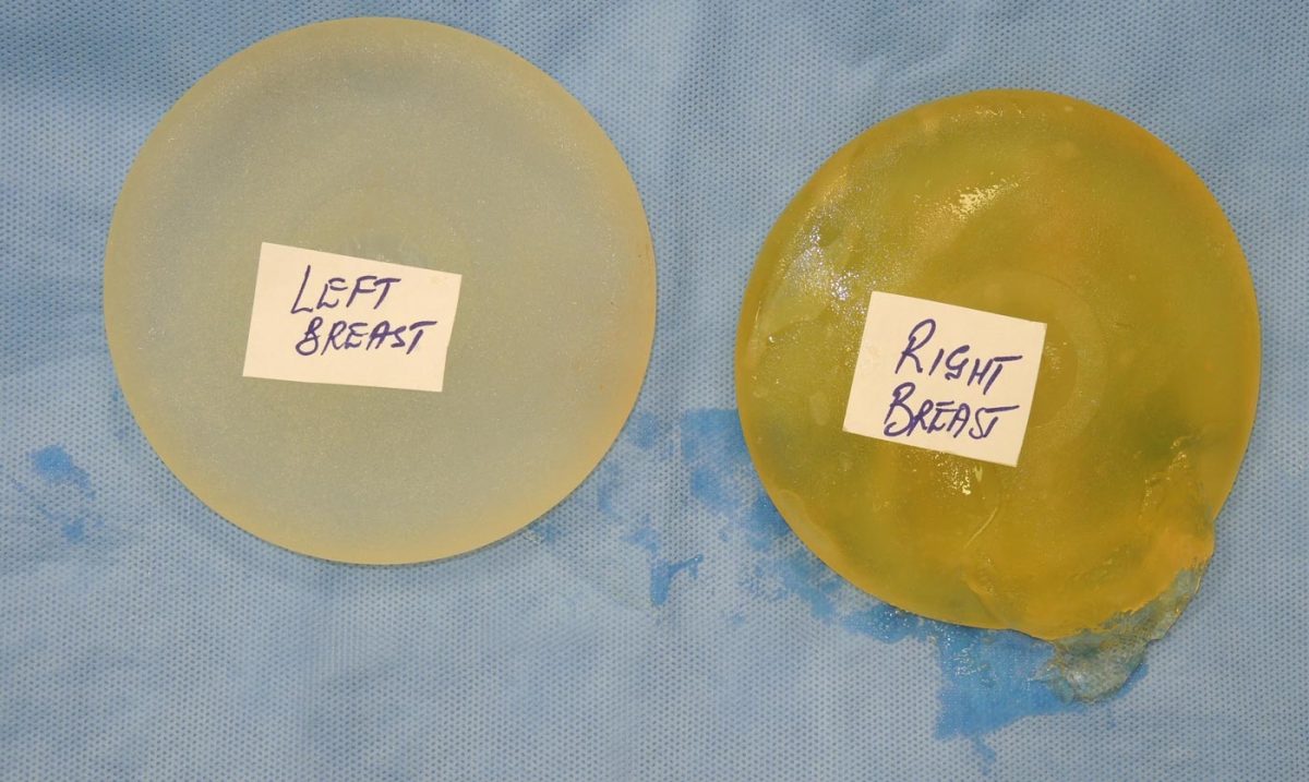 Corrective Breast Implant Surgery Paul Harris