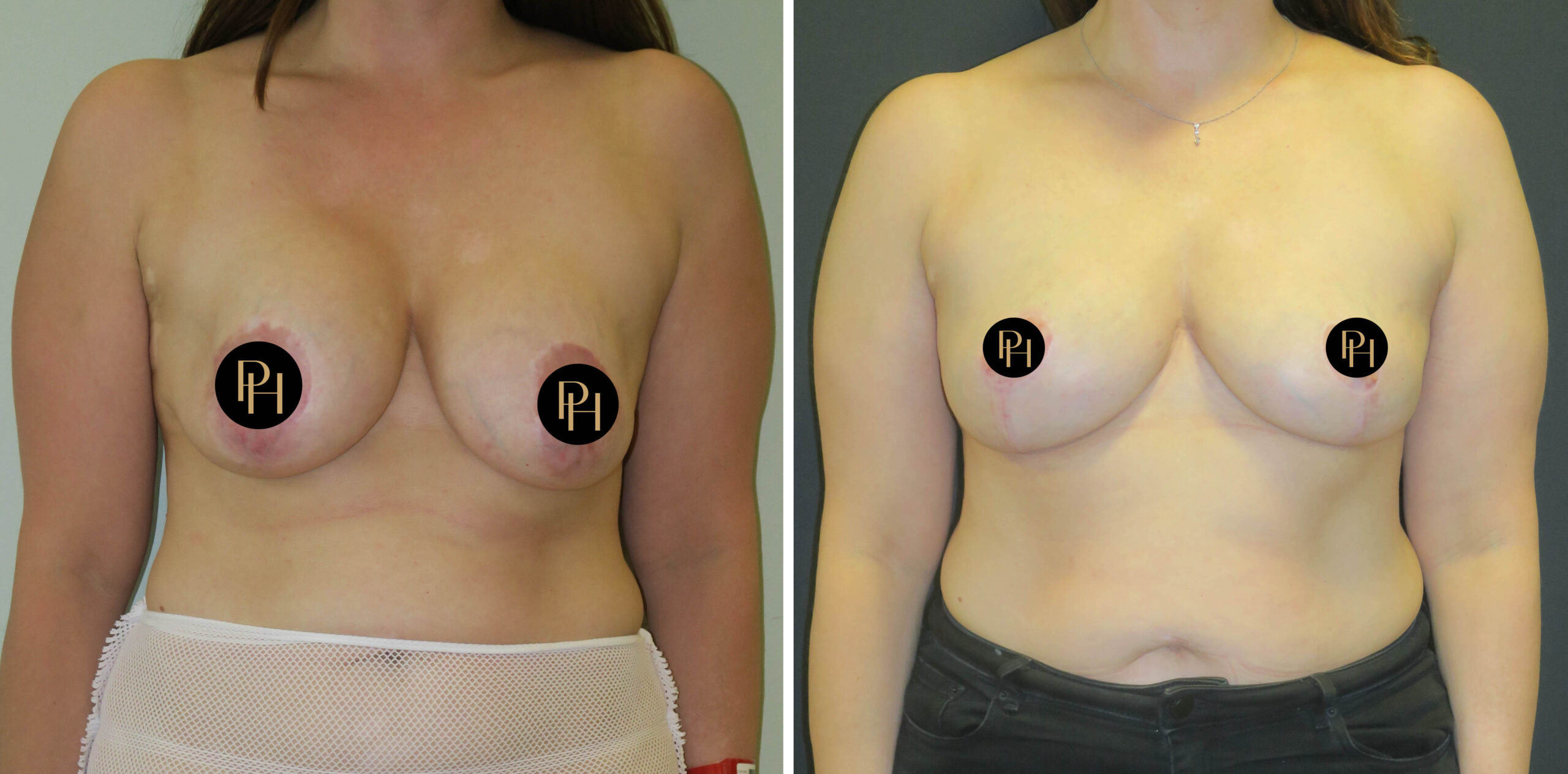 breast augmentation breast lift london breast surgeon london