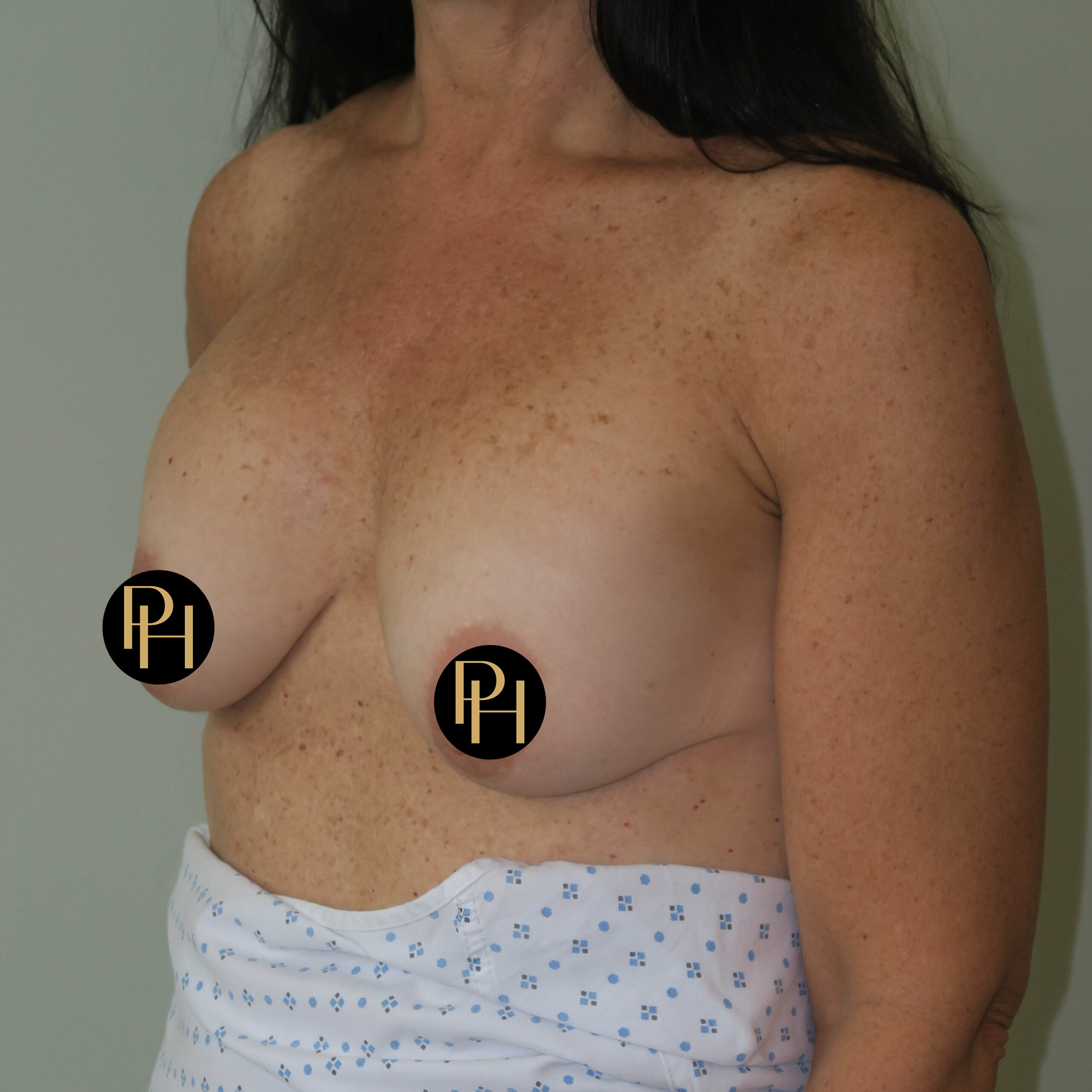 breast correction surgery