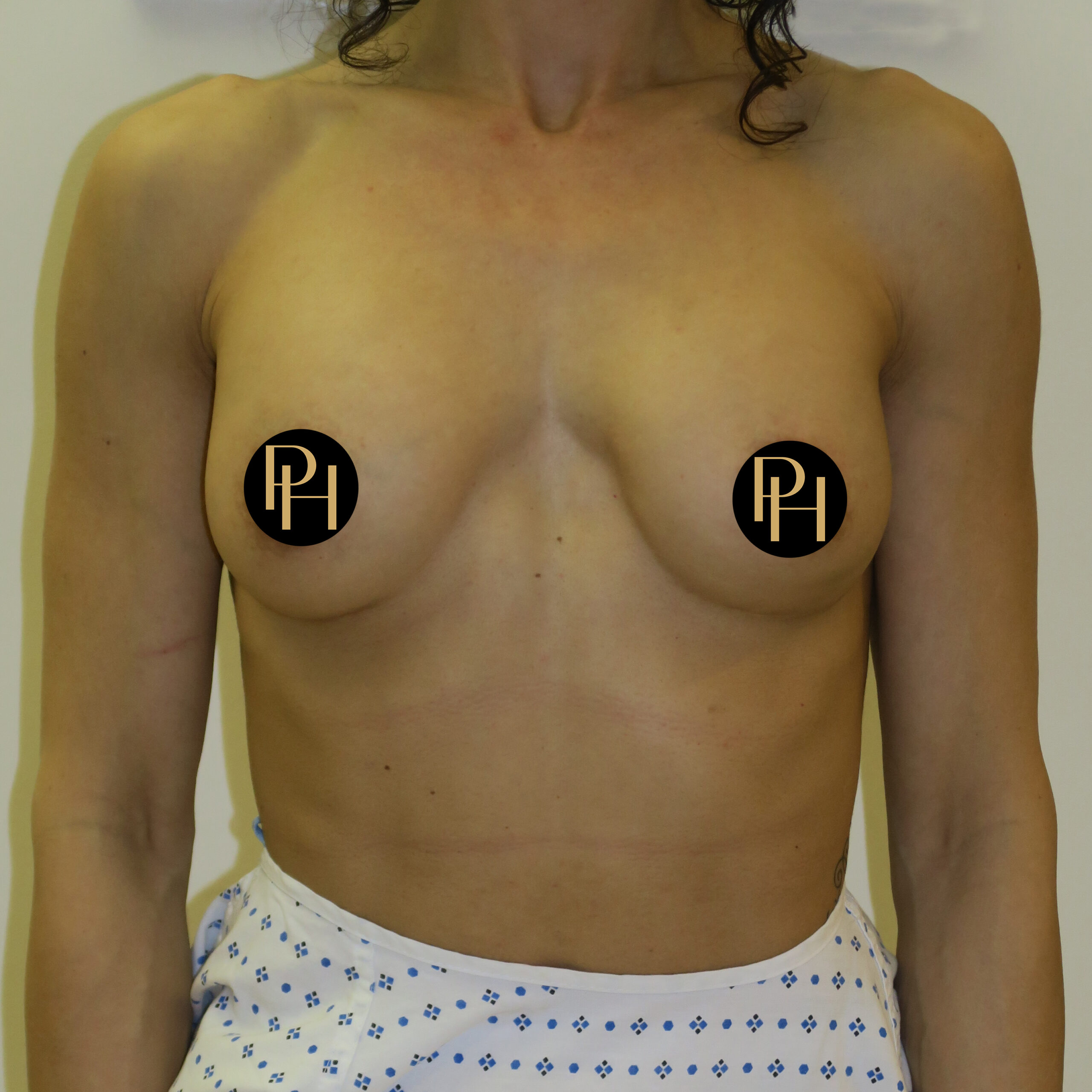 breast correction surgery